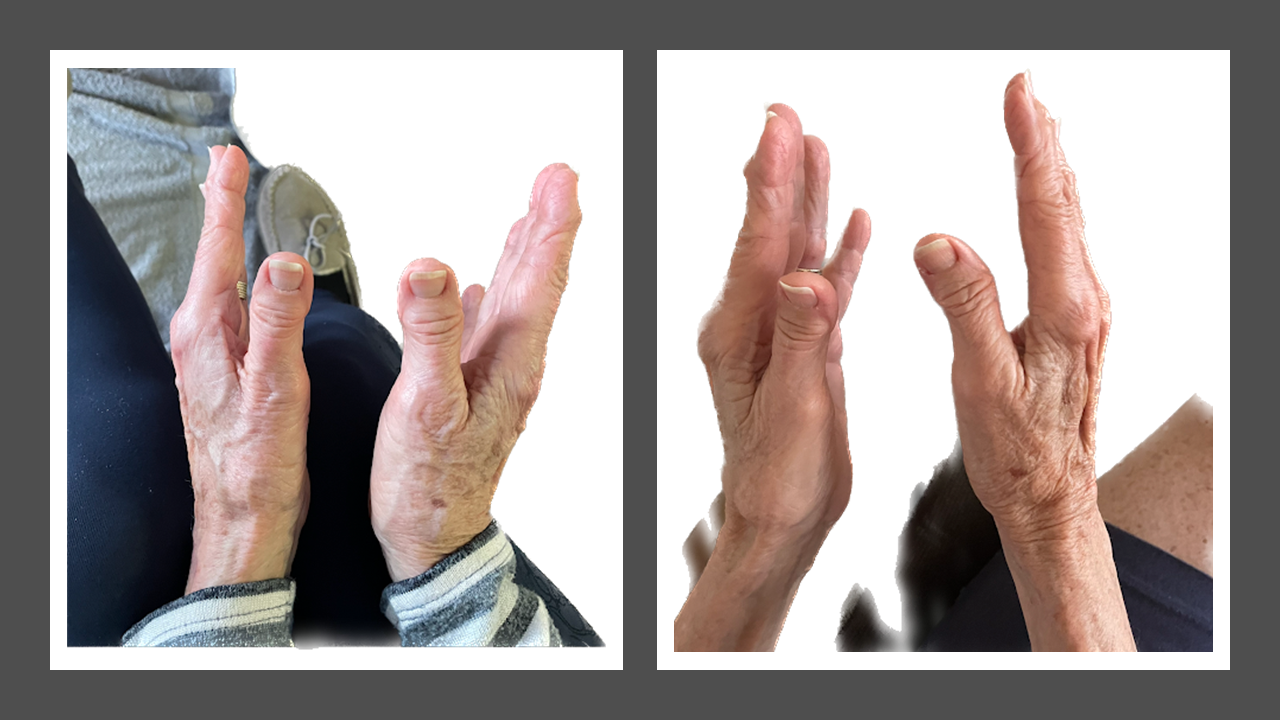 arthritis - December 18, 2022 - May 21, 2023